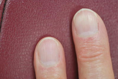 Changes in the Nails | Plastic Surgery Key