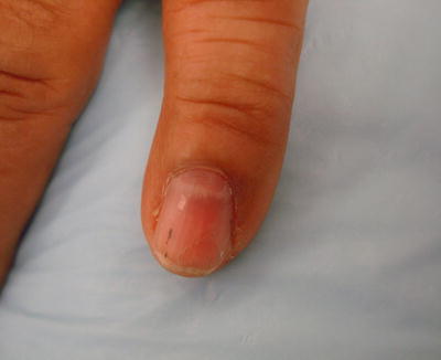 Changes in the Nails | Plastic Surgery Key