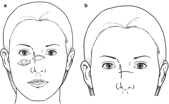 Nose | Plastic Surgery Key