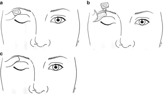 Eyelids | Plastic Surgery Key