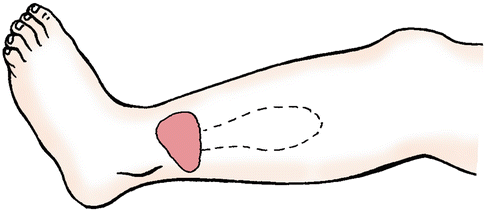 Peroneal Artery Perforator Flap Plastic Surgery Key