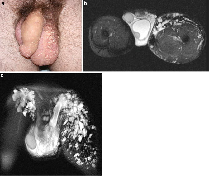 scrotal lymphedema