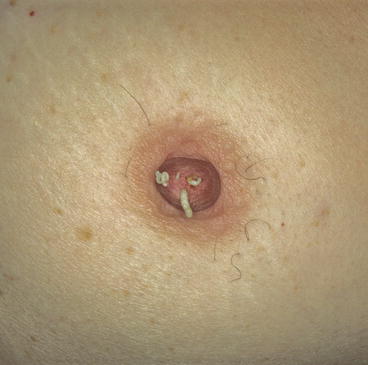 Yellow Nipple?, When Occurs