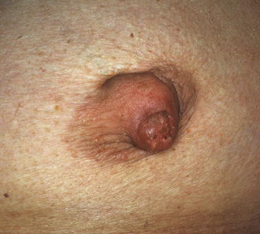 a) Photograph of a woman's breast shows slitlike retraction of the