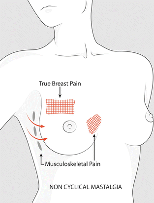 Breast Pain (Mastalgia)