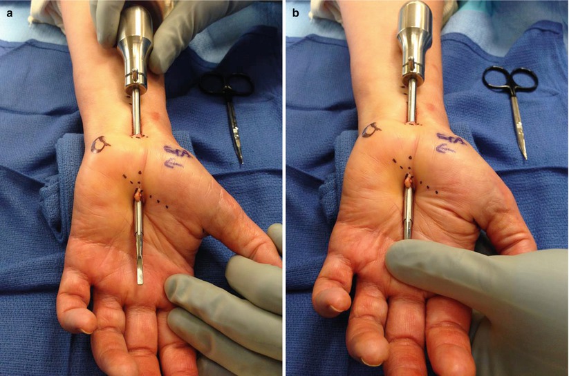 endoscopic carpal tunnel release