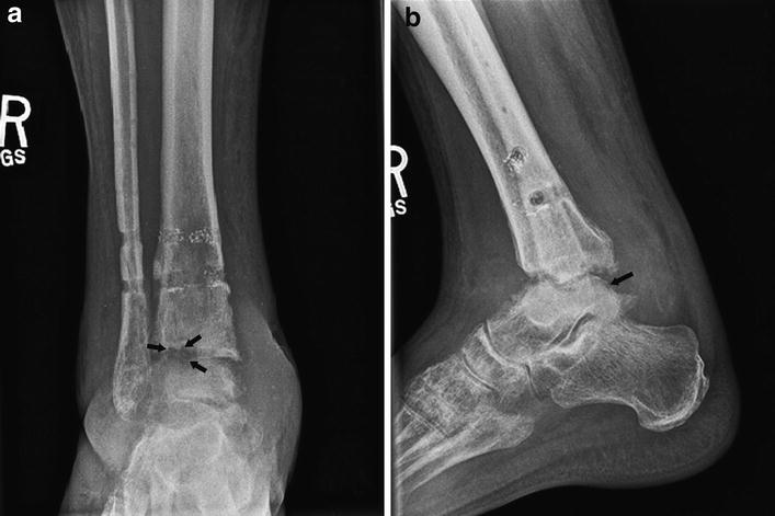 Posttraumatic Reconstruction of the Ankle Using the Ilizarov