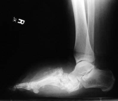 59: Charcot Reconstruction with External Fixation ...