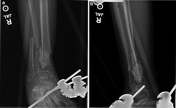 33 Iiib Segmental Open Tibial Plafond Fracture Treated With