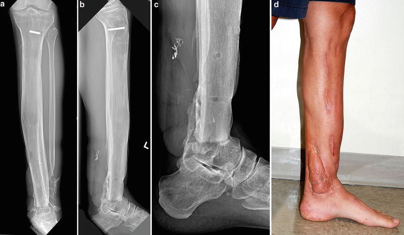 31: GIII B Open Pilon Fracture. Spacer, Flap, And 13.5 Centimeter Bone ...