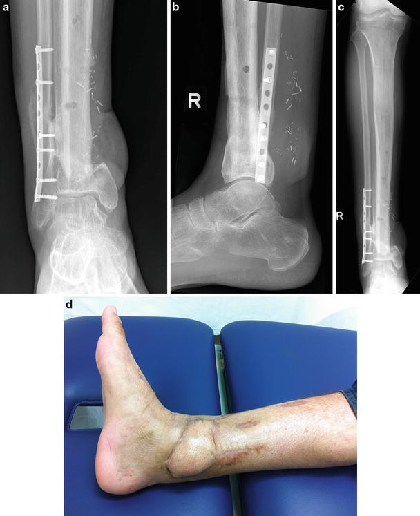 32: GIII B Pilon Fracture With Segmental Bone Loss | Plastic Surgery Key