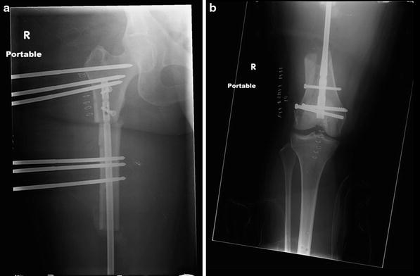 6: A 10 cm Traumatic Femoral Defect Treated with a ...