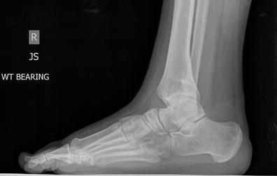 67: Clubfoot Sequela Treated with a Multilevel, Hexapod, External ...