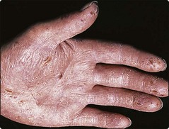 Eczema – Basic principles/contact dermatitis | Plastic Surgery Key