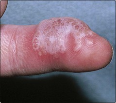 herpes on knuckles