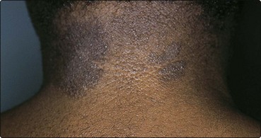 Racially pigmented skin | Plastic Surgery Key