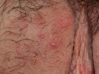 folliculitis genital area