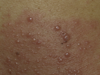 Pustules Vesicles Bullae And Erosions Plastic Surgery Key