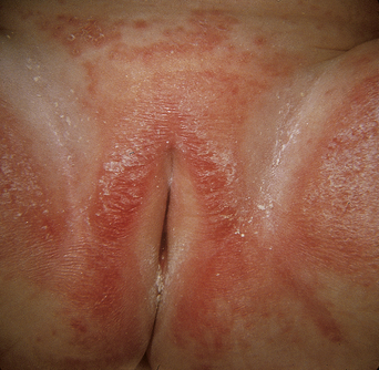 Female Genital Sores