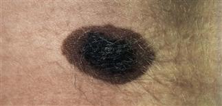 junctional melanocytic nevus