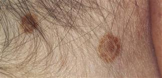 intradermal nevus