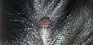 intradermal nevus