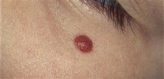 intradermal nevus