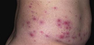 Pseudomonas Folliculitis Plastic Surgery KeyPlastic Surgery Key Pseudomonas Folliculitis Plastic Surgery KeyPlastic Surgery Key