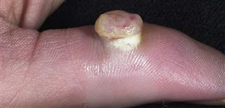 pyogenic granuloma finger