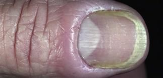 Nail diseases: Paronychia, Pseudomas infection, white spots or bands ...