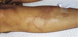 Leprosy (Hansen disease)