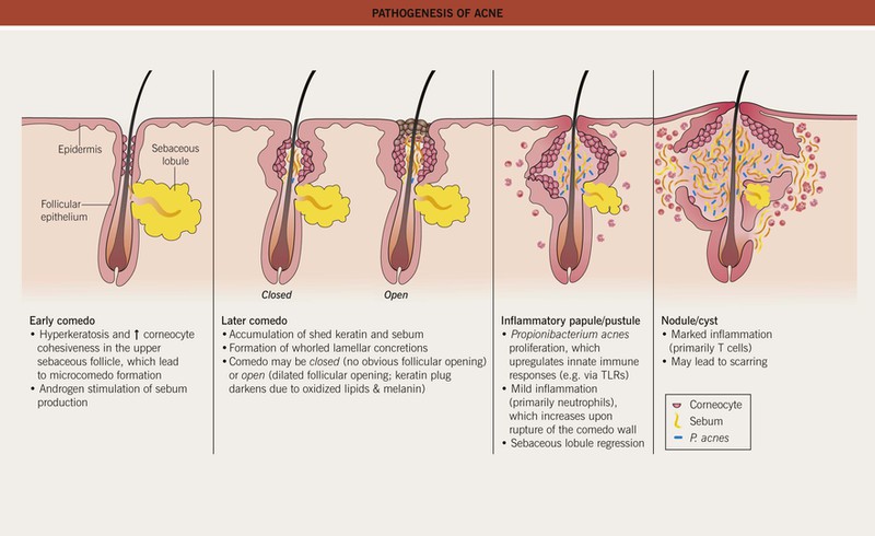 mild cystic acne diagram