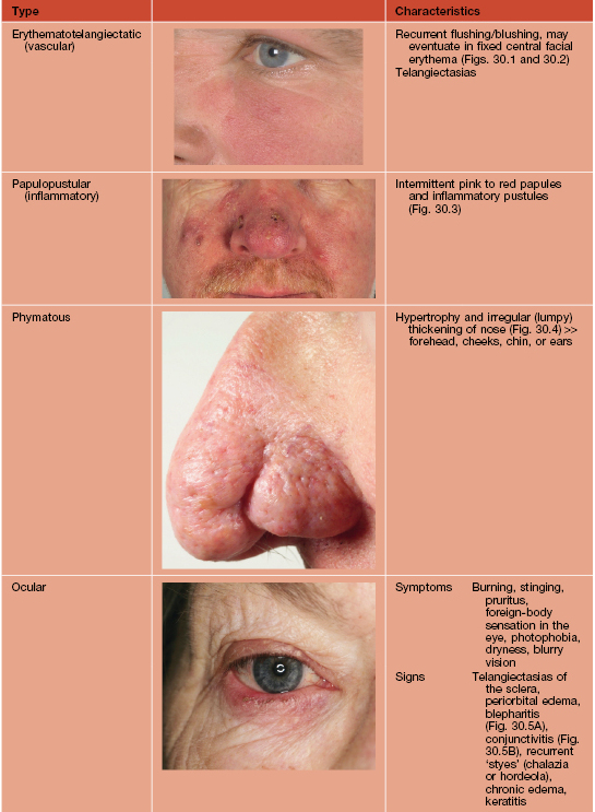 Rosacea, seborrhea kezelése - Dr. Pellion Szilvia Budai Esztétikai Bőrgyógyászat