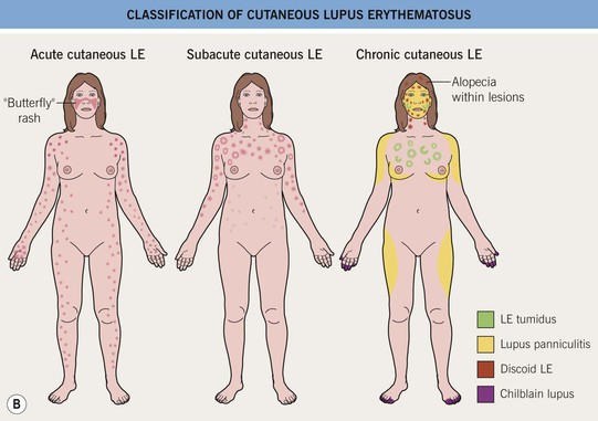 chronic cutaneous lupus