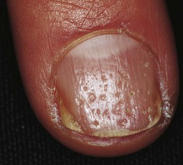 Nail Disorders | Plastic Surgery Key