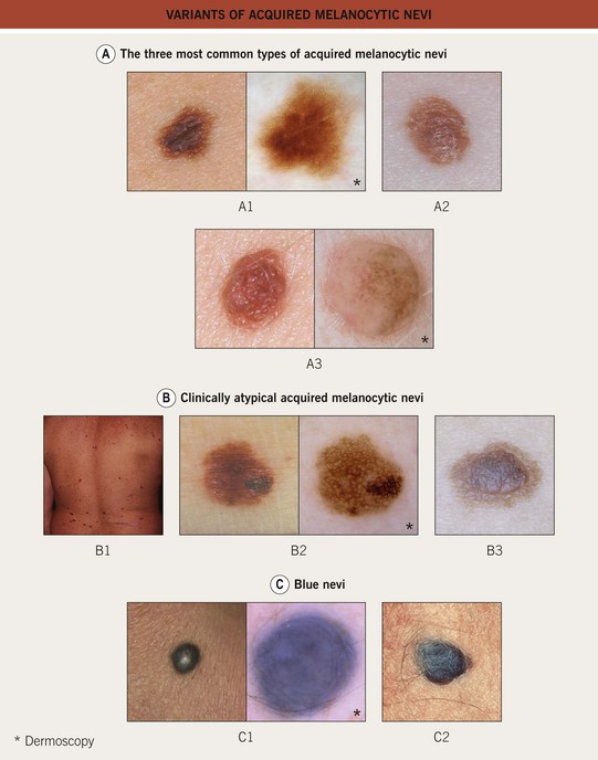 Acquired Melanocytic Nevus