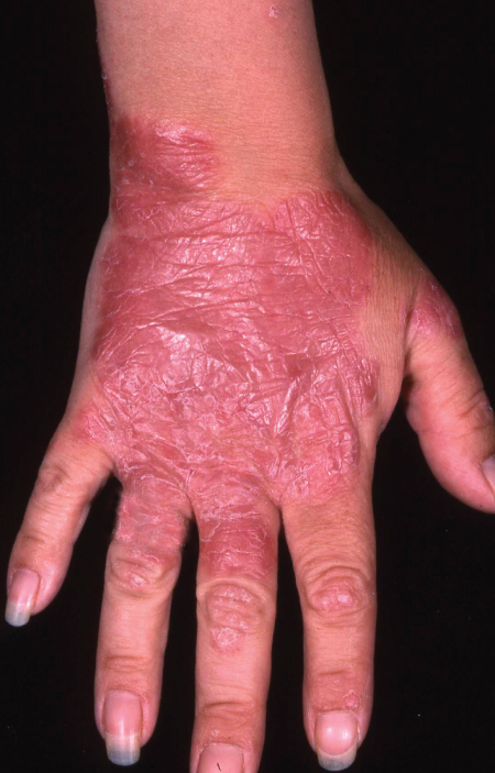 Management of Psoriasis | Plastic Surgery Key