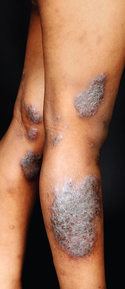 Eczema of legs on Black skin with erythema and lichenification