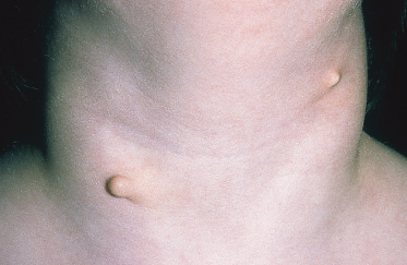 multiple skin tags on neck