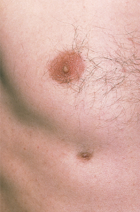 Third Nipple (Supernumerary Nipple): Causes, Types & Removal