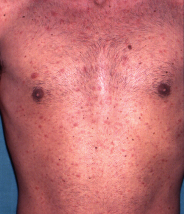 maculopapular rash hiv