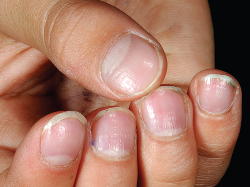 Peeling Nails: Causes and Treatments | POPSUGAR Beauty