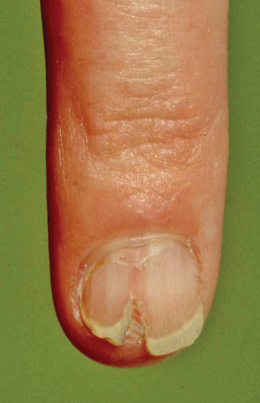 Nail Dystrophy in Patients with Atopic Dermatitis and Its Association with  Disease Severity