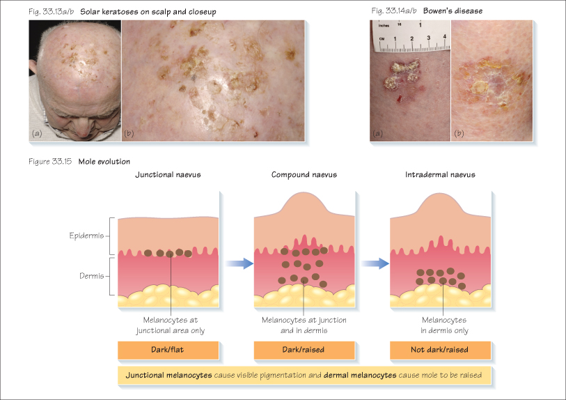 Types Skin Lesion Chart