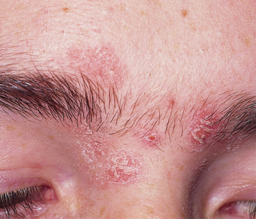 Eczema On Eyebrows