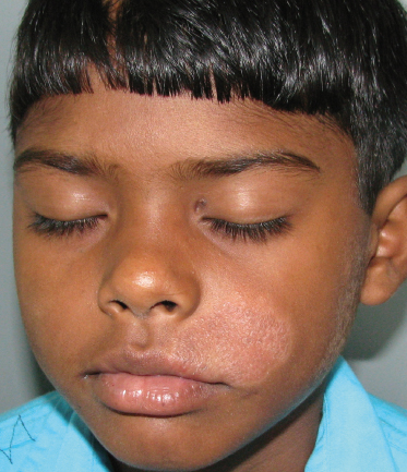 Leprosy in Plastic Surgery