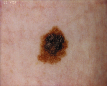 congenital nevus melanoma