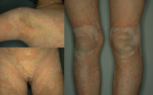 ichthyosis bullosa of siemens