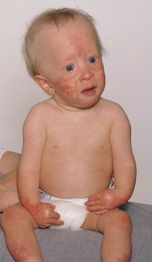 136-rothmund-thomson-syndrome-bloom-syndrome-dyskeratosis-congenita-fanconi-anaemia-plastic