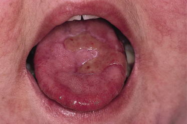 147 Diseases of the Oral Mucosa and Tongue | Plastic Surgery Key